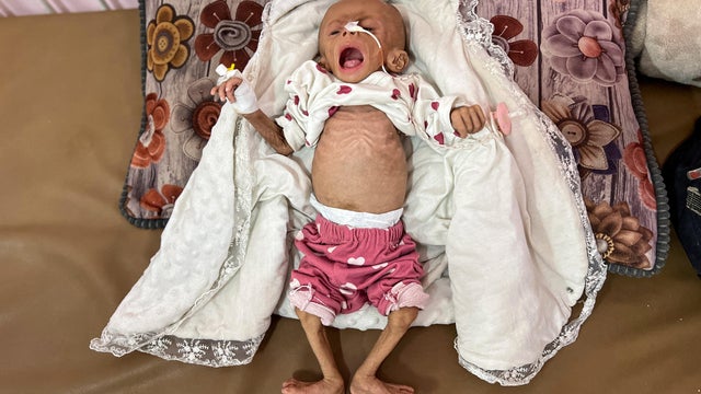 Palestinian mother mourns 3-month-old who died due to malnutrition, according to medics, in Khan Younis 